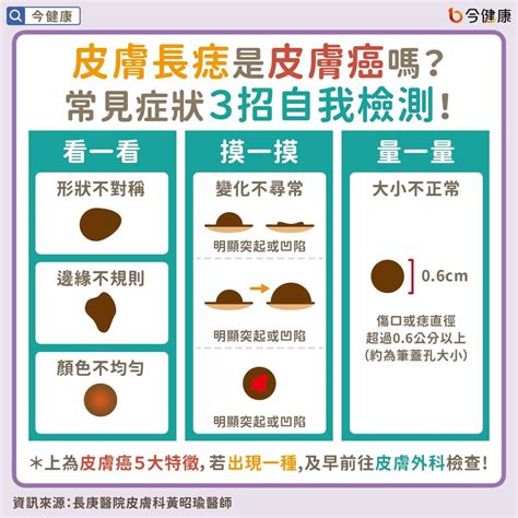 凸起來的痣|皮膚長痣是皮膚癌嗎？常見症狀，簡單3招自我檢測｜ 